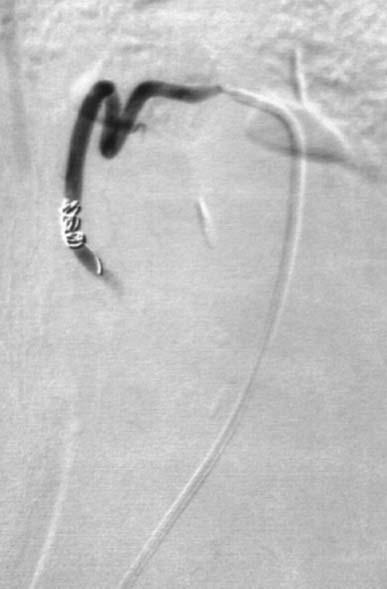 890 M. Nakajo et al. Embolization of a ruptured aneurysm of the ovarian artery with coils has been reported in 2 cases (4, 6).
