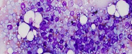 Mast cell sarcoma Extremely rare Localized and destructive growth of