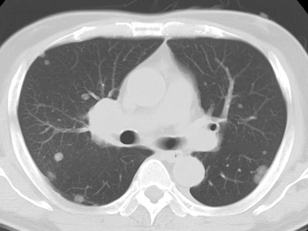 Fig. 5: One year later, multiple metastases were