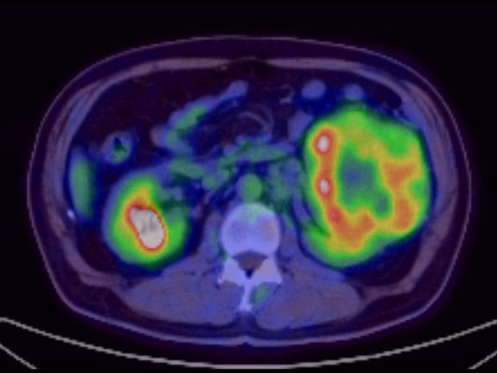 Fig. 4: FDG-PET also showed high uptake in the tumor.