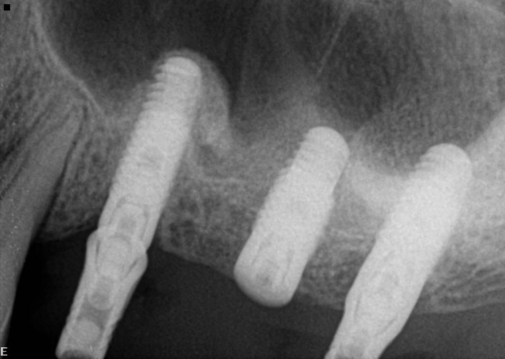 Case 2: In Implant Surgery Thin Buccal Bone