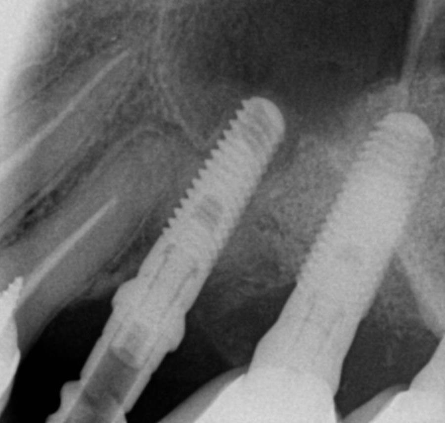 Case 3: Implant in the Aesthetic Zone