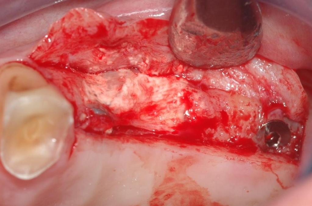 Case 4: Thin Buccal Bone OSSIX VOLUMAX