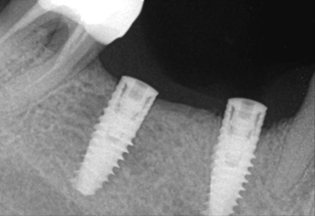 Periodontal Attachment Loss Gain of vertical and