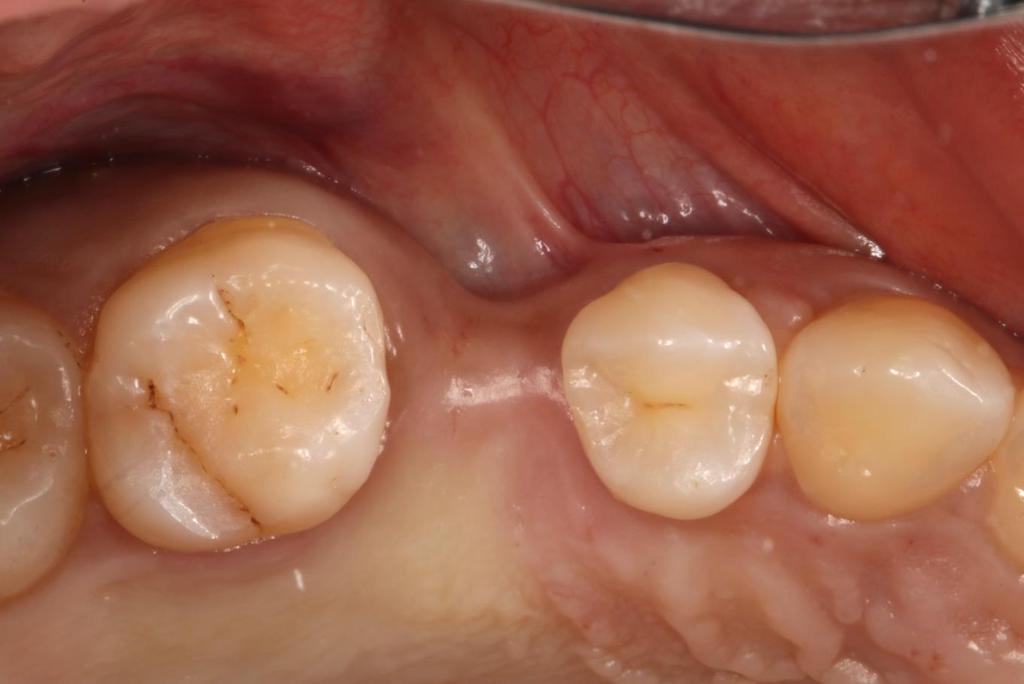 Case 6: Deep Buccal Depression in Aesthetic Zone Implant is Placed with a Healing