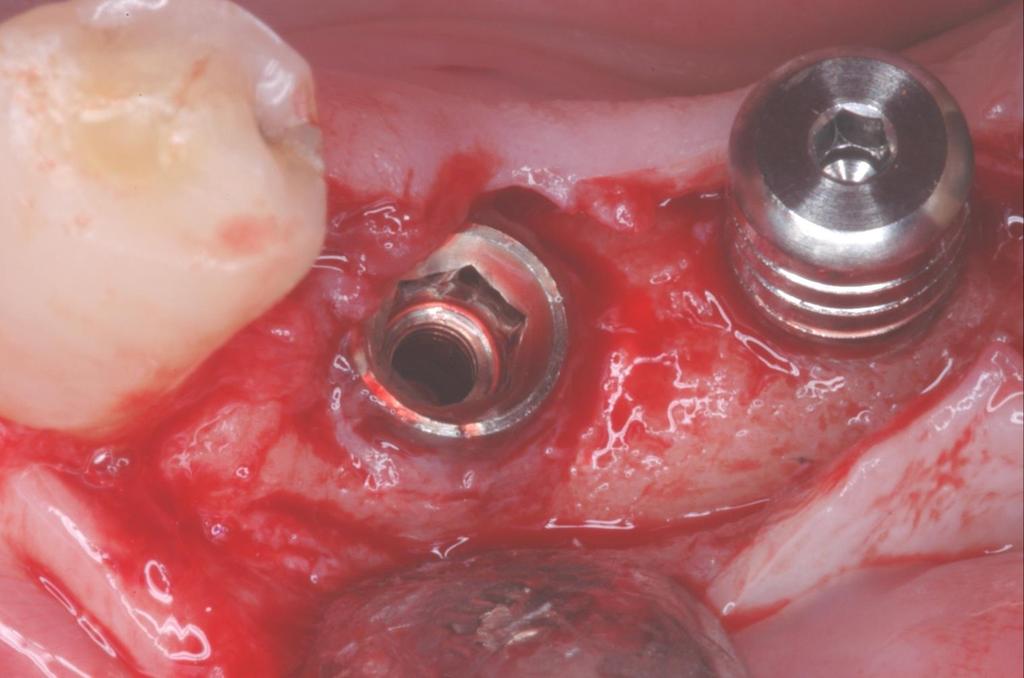 Case 8: Peri-Implant Bone