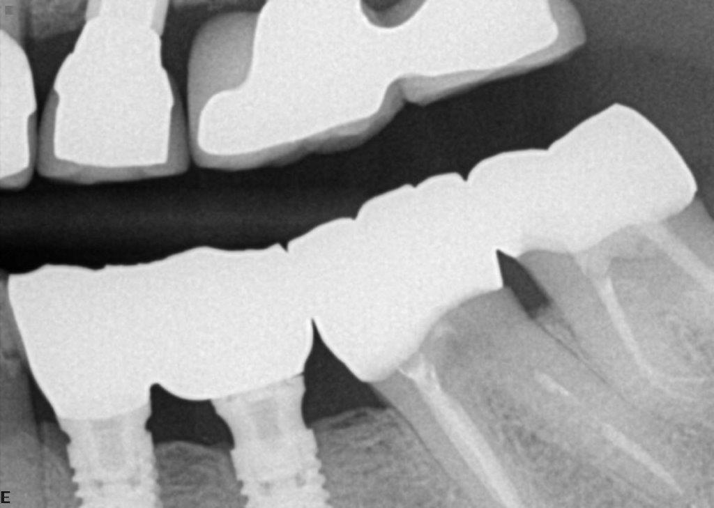 Case 8: Peri-Implant Bone Loss Crestal Bone