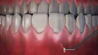 Root Coverage Transformed: No Incisions, No Sutures, No Grafting Ten Teeth in One Hour Gingival Recession Patented PST instruments Raising and advancing flap Collagen placed with PST patented Chao