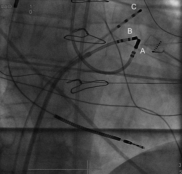 Roten L et al, Alcohol septal ablation 182 Figure 2: Antero-posterior fluoroscopic view of bipolar catheter ablation from the left and right ventricular outflow tracts.