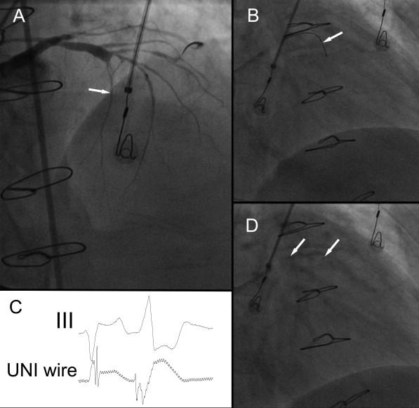 Roten L et al, Alcohol septal ablation 183 Figure 3: Ethanol ablation of the first septal perforator. A: Angiogram of the left coronary arteries (RAO 45 view).