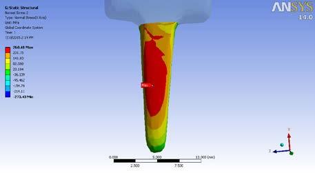 analysis of the Swanson implant, also this work was useful for comparison of the finite element results with the analytical solution for the geometry.