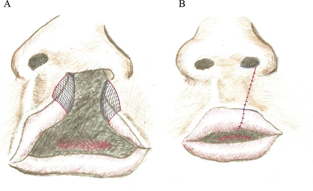 Surgical Techniques for Treatment of Unilateral Cleft Lip http://dx.doi.org/10.5772/67124 81 the vermilion closure [20].