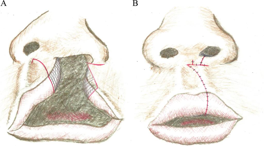 82 Designing Strategies for Cleft Lip and Palate Care Millard preserved anatomical landmarks: the cupid's bow and the philtral column.