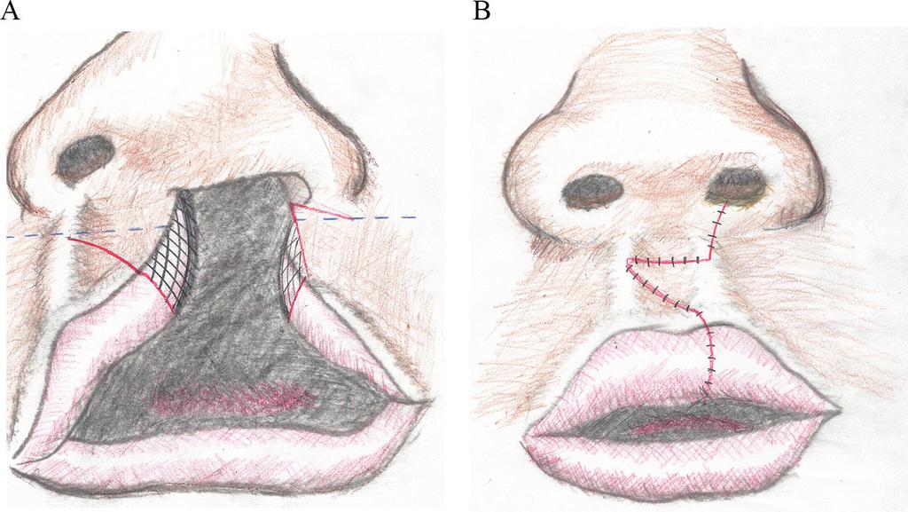 84 Designing Strategies for Cleft Lip and Palate Care Figure 9. (A) Schematic representation of the incisions for a LeMesurier repair.