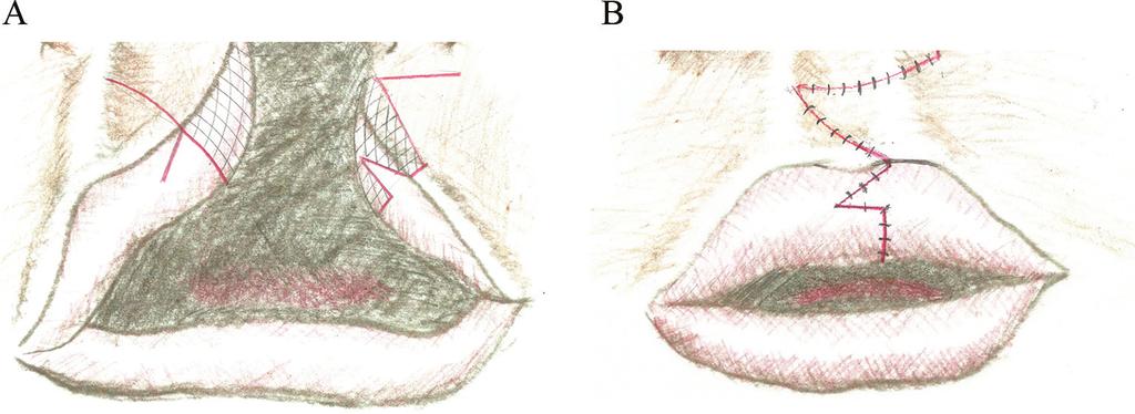 86 Designing Strategies for Cleft Lip and Palate Care Figure 12. (A) Schematic representation of the incisions for a Fisher repair. (B) Schematic representation of the closure of a Fisher repair. 6.5.