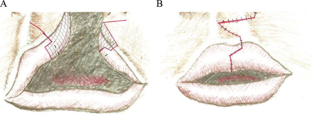 Surgical Techniques for Treatment of Unilateral Cleft Lip http://dx.doi.org/10.5772/