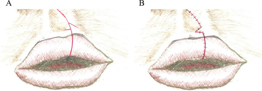 88 Designing Strategies for Cleft Lip and Palate Care Figure 15. (A) Schematic representation of closure of a cleft repair with the cupid's bow under rotated.