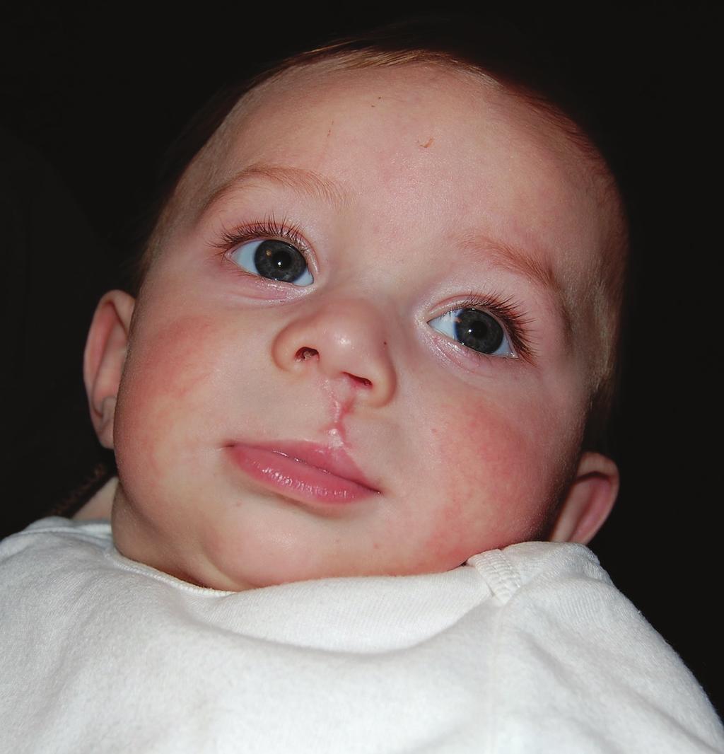 90 Designing Strategies for Cleft Lip and Palate Care infant with unilateral cleft lip. I observe his similar scrupulous attention to detail and excellent technique.