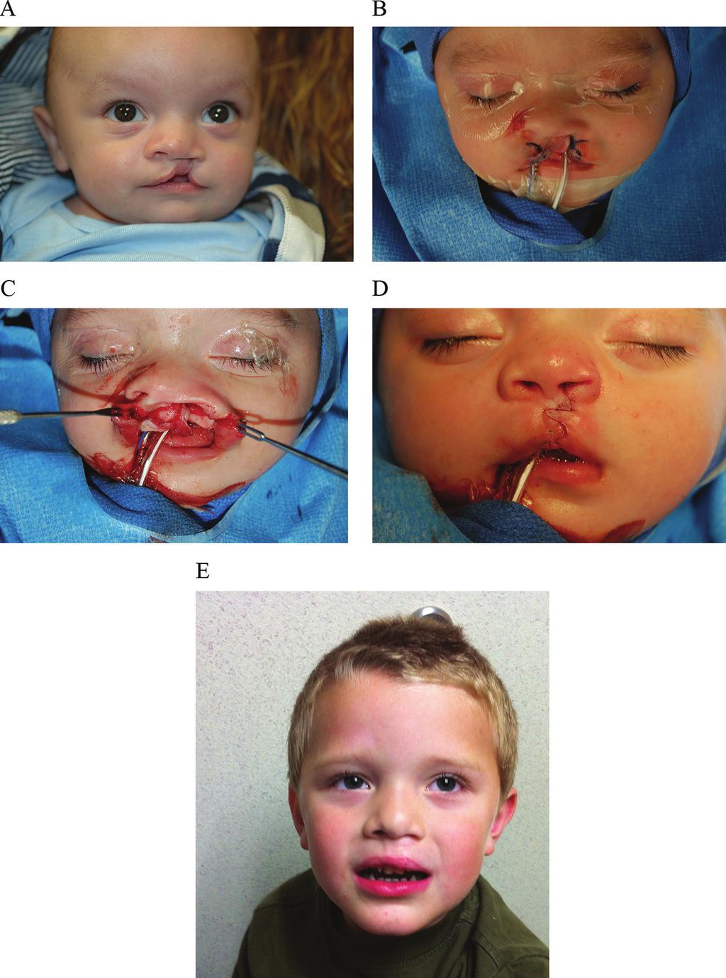 Surgical Techniques for Treatment of Unilateral Cleft Lip http://dx.doi.org/10.5772/67124 91 Figure 17. (A) An infant with a complete unilateral cleft lip.