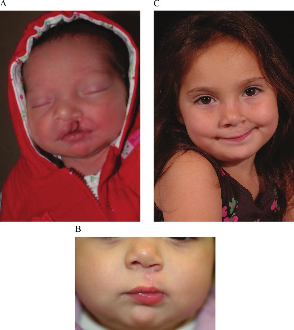 92 Designing Strategies for Cleft Lip and Palate Care In my opinion, this technique yields very satisfactory results (Figure 18). Figure 18.