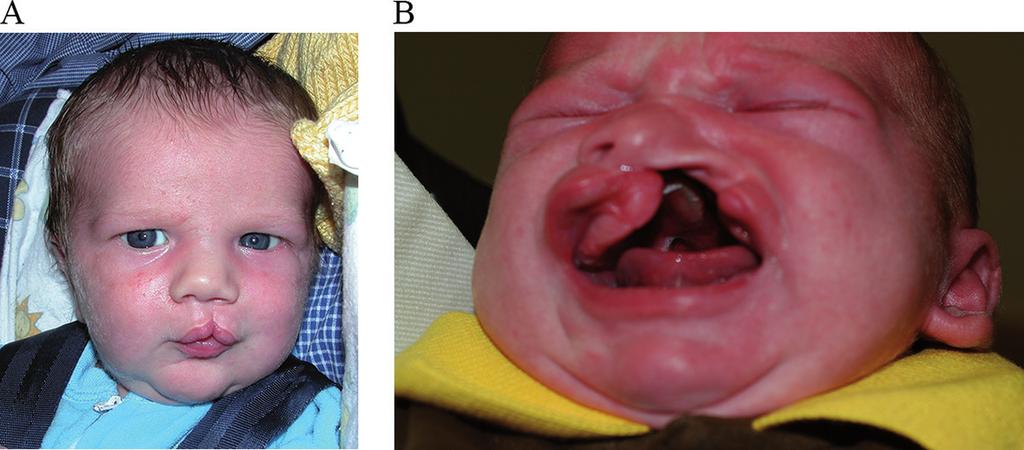 74 Designing Strategies for Cleft Lip and Palate Care The pathologic origins of a cleft lip are traceable to distinct embryological events.