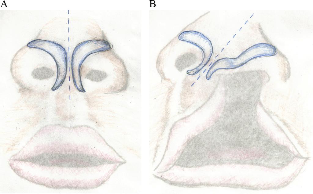 76 Designing Strategies for Cleft Lip and Palate Care (Figure 3A). The scroll area refers to the overlapping of lateral crura with the caudal edge of upper lateral cartilages.