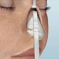 How an Open Rhinoplasty Works During an open rhinoplasty procedure, the physician makes small incisions across the columella and inside each nostril.