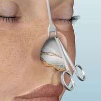 Using a retractor to expose the inside of your nose, the physician will make a second incision, known as a marginal incision, which extends from the columella incision into each nostril.