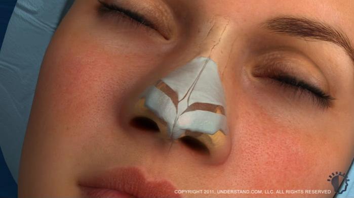 Procedure In patients whose nasal tip is wide or bulbous, the surgeon may choose to remove a portion of the alar cartilage from the tip of the nose.