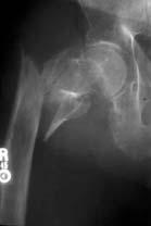 Peritroch Hip Fractures Should be treated with an IMHS Robert M Harris MD Hip Fractures General principles Approximately 250,000 hip fractures/ year Cost approximately $8.