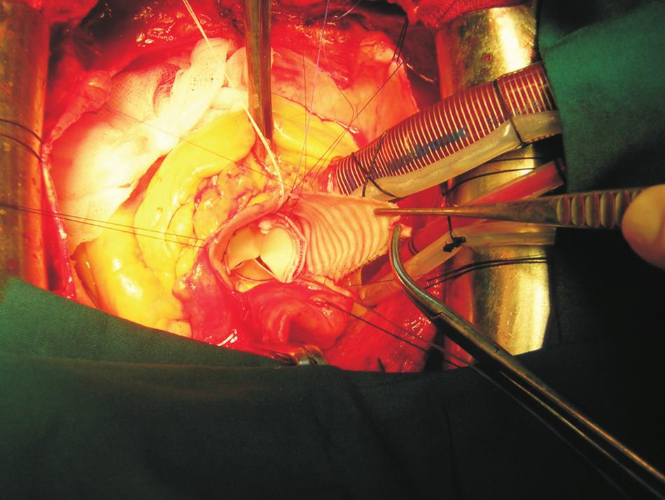 K. St. Rammos et al. / Interactive CardioVascular and Thoracic Surgery 5 (006) 749 754 751 Fig. 1.