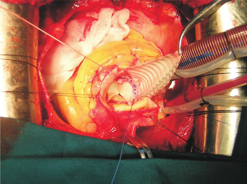 . The prosthesis (area of divided non-coronary sinus) is sewn to the appropriate level of the synthetic graft after careful orientation.