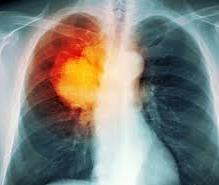 IER Lung cancer Consistent with China cohort study results for impact of long term use of