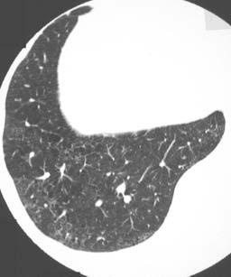 a) HRCT image taken at the time of biopsy showing ground-glass opacity, and centrilobular nodules and their superimposition.