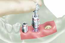 34 System Preparing the abutment 18 28 36 43 39 51 Internal Hex Implants AdVent Implants (4.