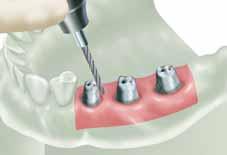 Note: The reduction of the abutment needs to take into consideration the following: 1) Type of restoration (for example, a ceramic or metal margin). 2) Desired thickness of alloy.