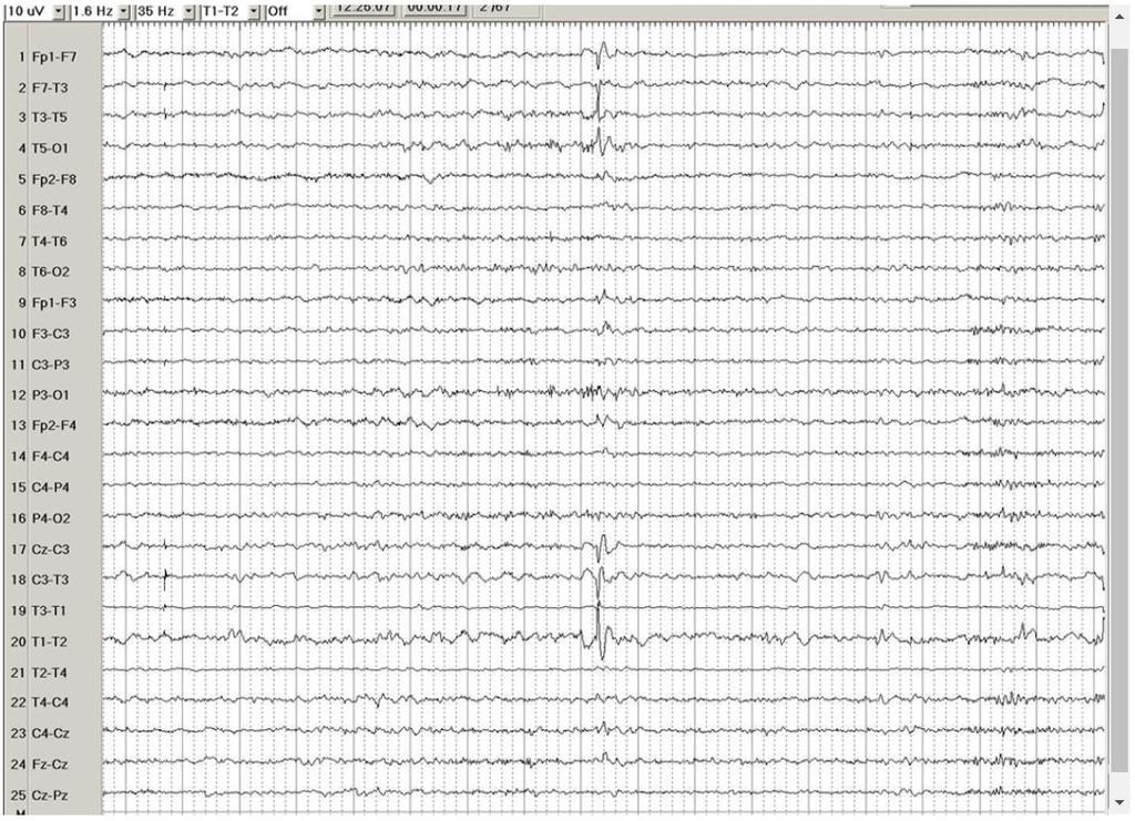 EEG in a 24-yearold woman, showing a left temporal interictal epileptiform discharge during stage 2 sleep, in