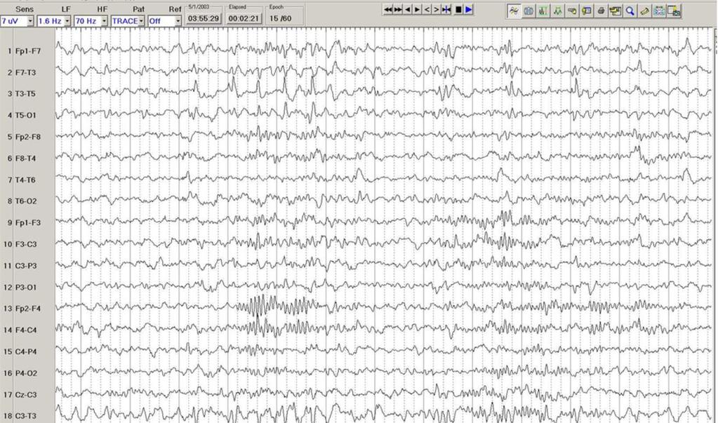 Ictal EEG of medically intractable partial epilepsy Interictal background immediately before the seizure,