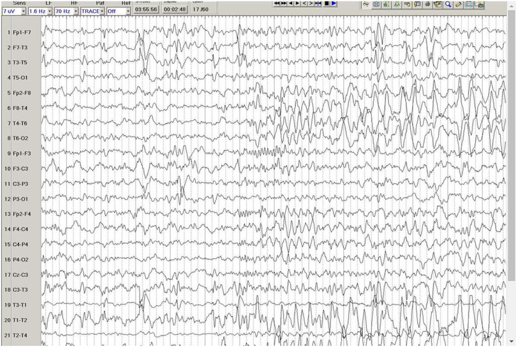 Onset of a rhythmic theta-delta discharge in the right frontotemporal