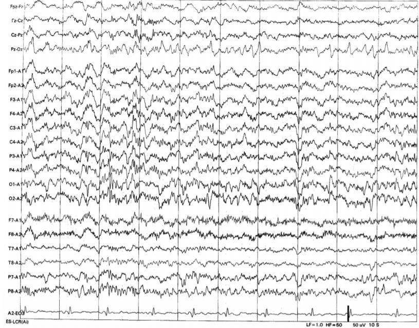 14 and 6 per second positive burst 13-year-old girl. Note the 14-Hz positive spiky waveforms best appreciated over the posterior temporal and biposterior head regions, best seen in the third second.