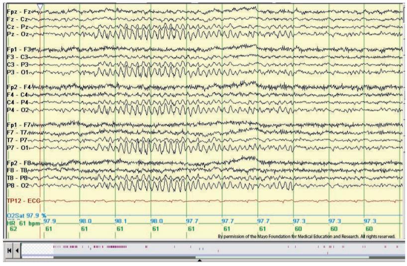 6 Hz Phantom Spike and Wave Adolescent patient. There are bilaterally symmetrical diffuse tiny spikes with prominent wave components ( mitten-like morphology) in seconds 3 through 6 below. St.