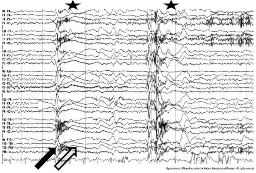 Lennox Gastaut Syndrome Figure 71. Tonic seizure. Recorded generalized tonic seizures leading to drop attacks (each recorded event marked by star).