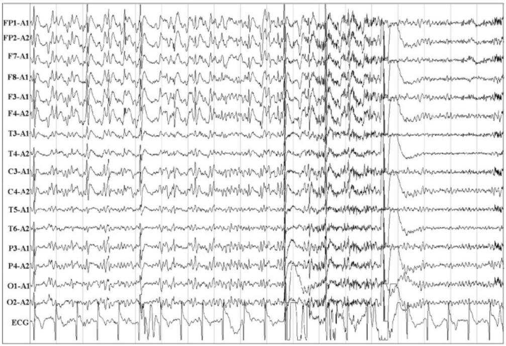 Juvenile Myoclonic Epilepsy Myoclonic seizure in a patient with JME.