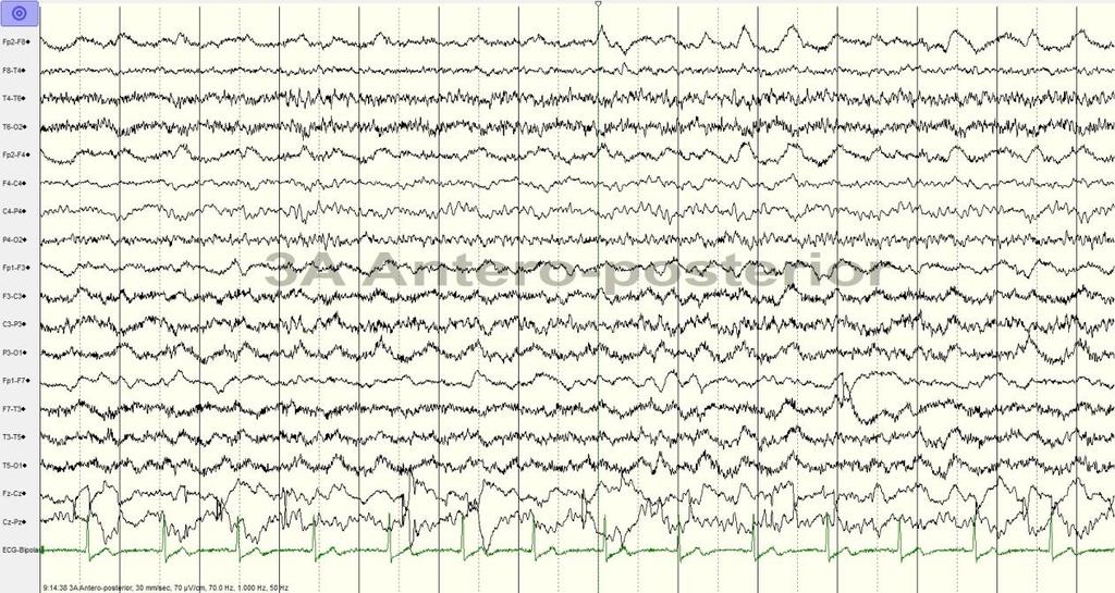 Serial EEG 6/2014 Right