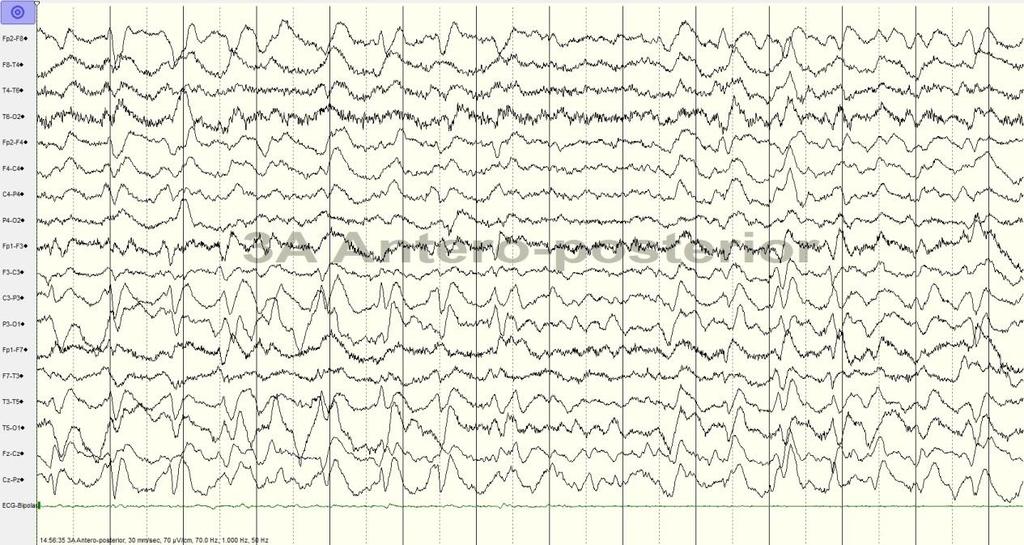 Serial EEG 7/2014 Right