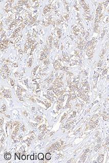 Fig 2a. Left: Insufficient staining result for HER-2 of the breast ductal carcinoma no.