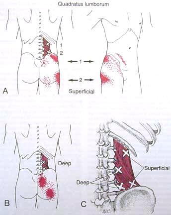 Signs of a QL Strain: Ø Tenderness along the 12th rib and/or iliac crest. Ø Can be injured on one side of the back or both. Ø Associated with muscle spasm. Ø Symptoms reproduced in certain positions.