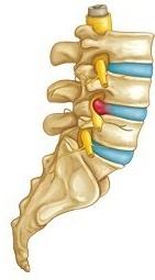 When large shear and/or twisting forces are applied to the spine, the outside layers of the disc can tear.