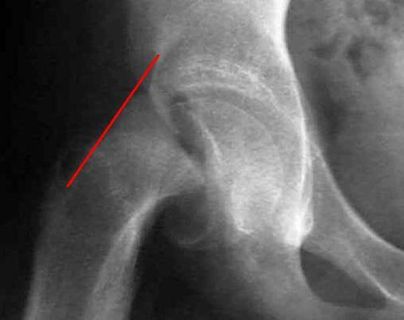 Slipped Capital Femoral Epiphysis Age: 10-16 years. Incidence: In USA is 10.8 cases per 100,000 children Boys > girls (M: 1.6:1) Race: more common in blacks.