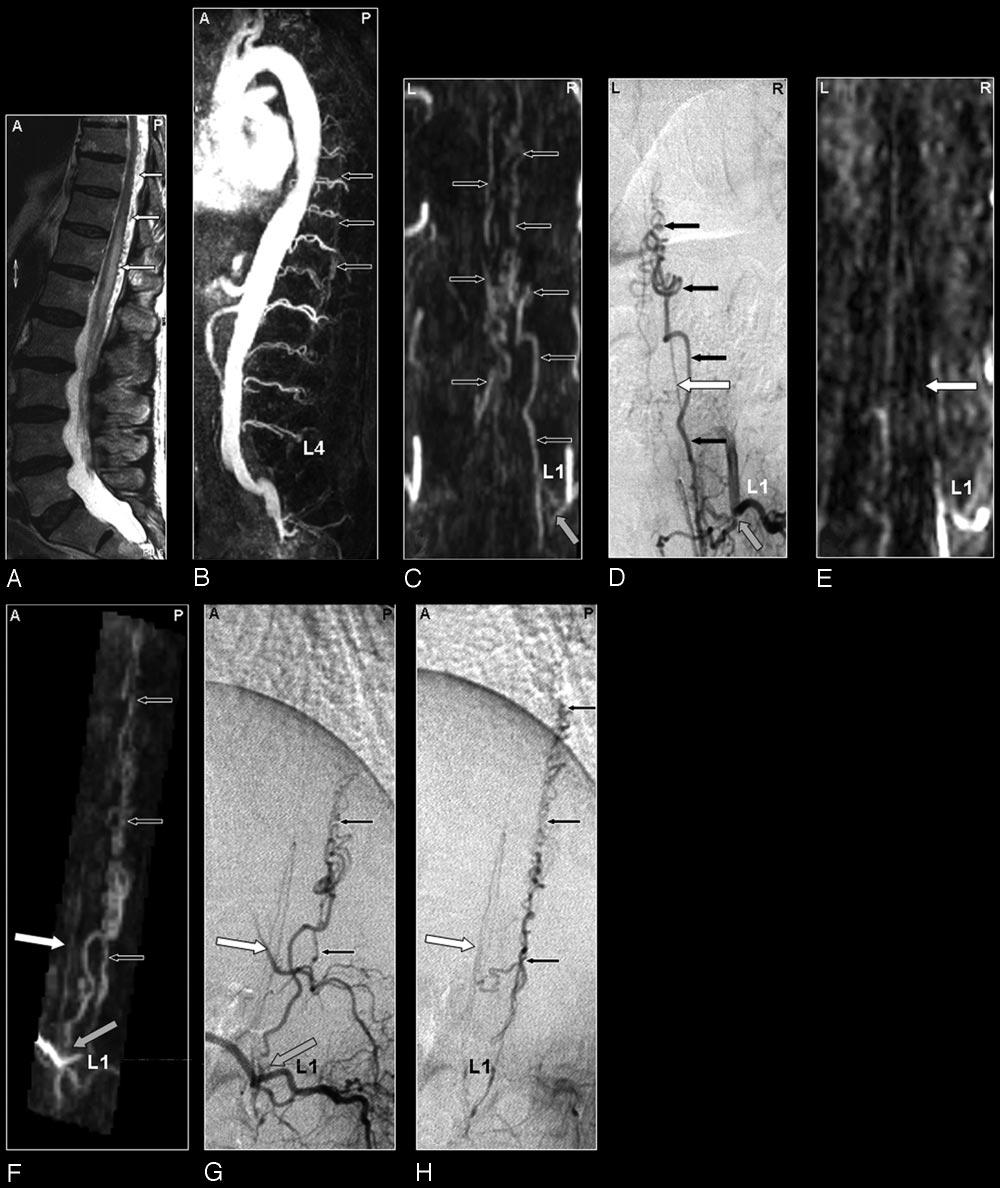 Fig 2. SDAVF in a 69-year-old male patient visualized by MRA and DSA. Demonstration of a normal spinal cord supplying artery and arterialized veins of a SDAVF supplied from the same segmental artery.